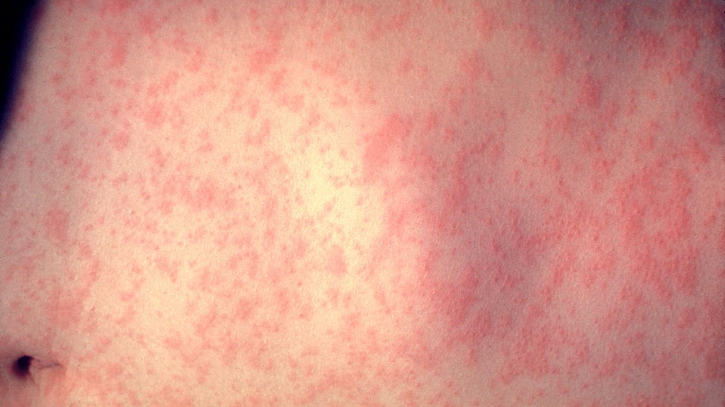 25 cases of measles identified in central, southeastern Minnesota, MDH says — WCCO / CBS Minnesota, Burnsville Health news